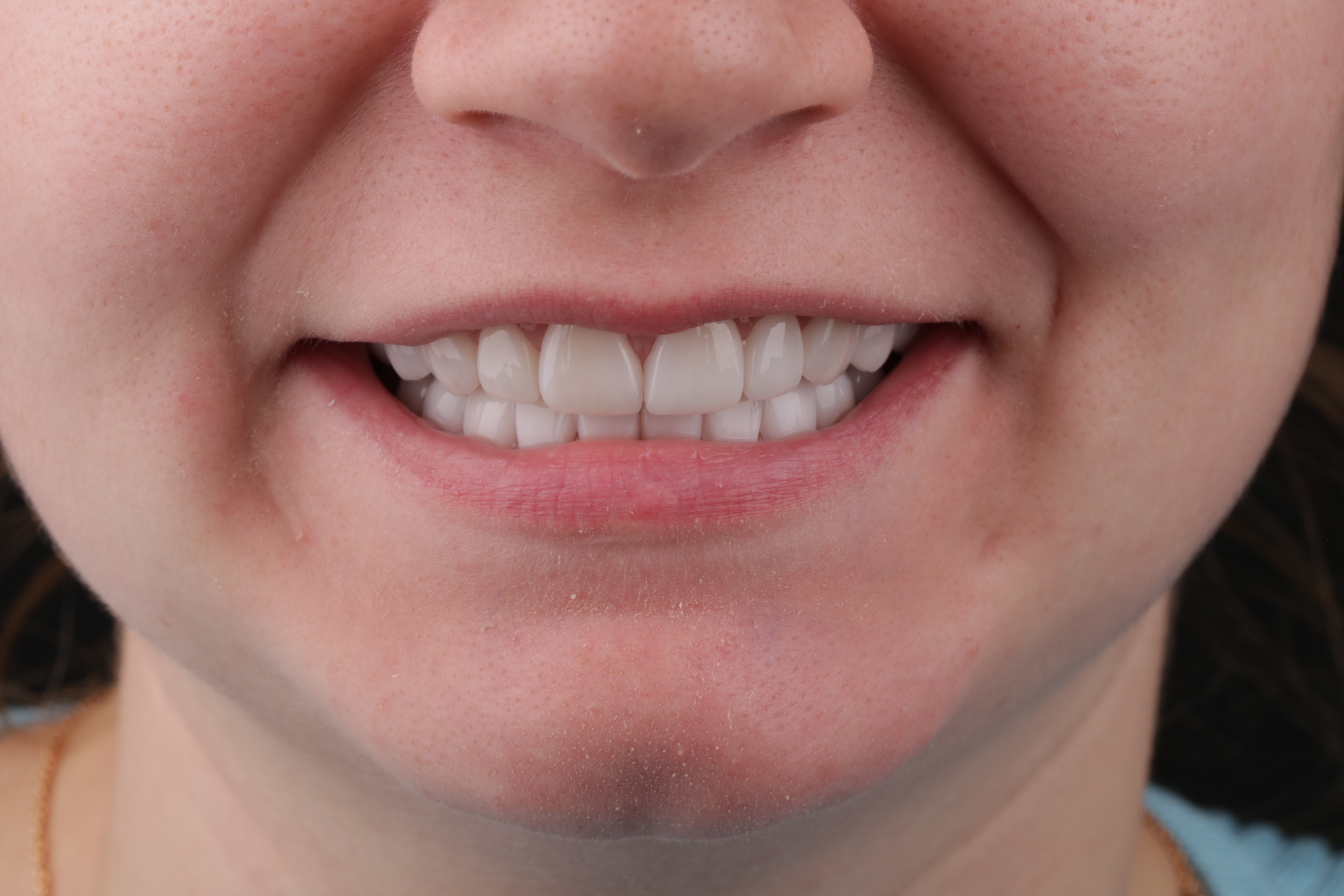 Après